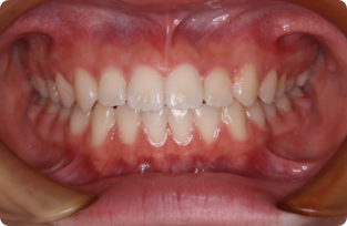 【21歳女性】舌側矯正 治療後