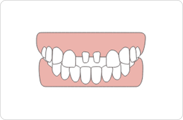 治療箇所の歯を部分的に削り、クラウンをかぶせるところのイラスト