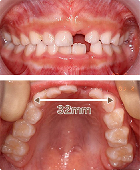 【6歳男子】叢生（そうせい）の予防＋取り外しの装置 治療前