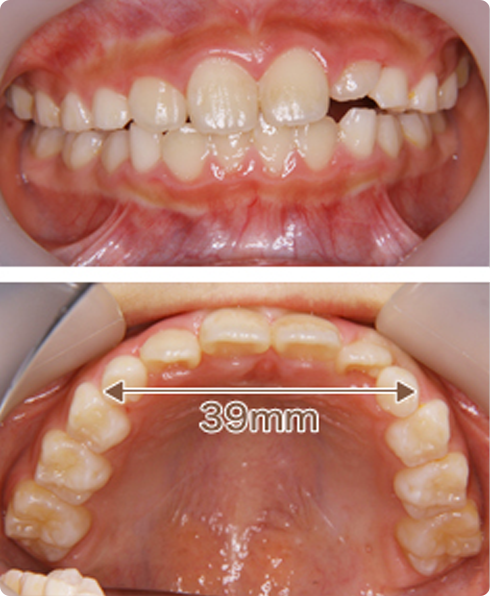 【6歳男子】叢生（そうせい）の予防＋取り外しの装置 治療後