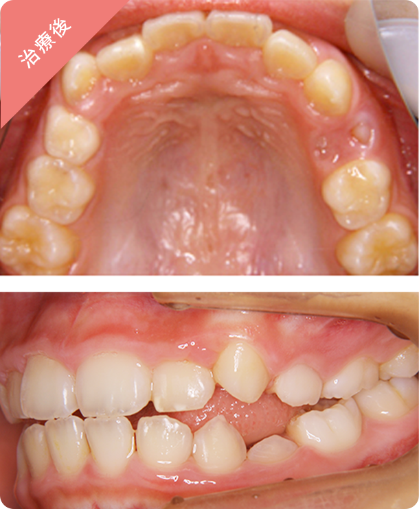 【9歳女子】取り外しの装置 治療後