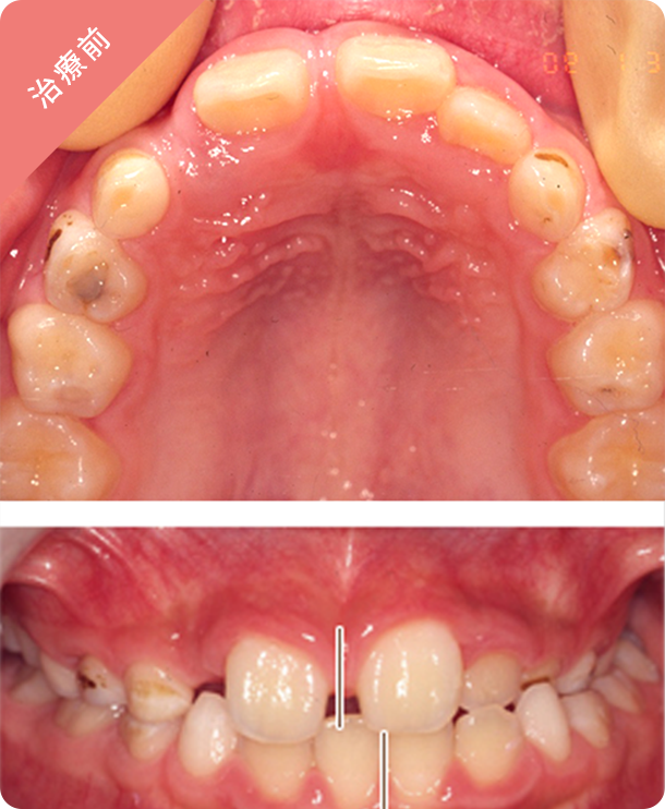 【8歳男子】固定式装置 治療前