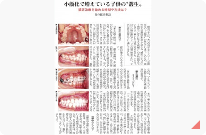 小顔化で増えている子供の〝叢生〟　記事