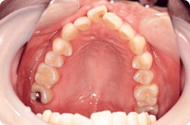 上顎右側中切歯１歯が突出していた写真
