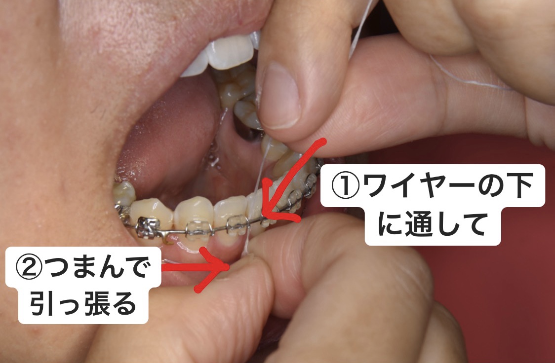 スーパーセール プラッカーズ 歯列矯正中の方に デンタルフロス 4袋計144本 Plackers